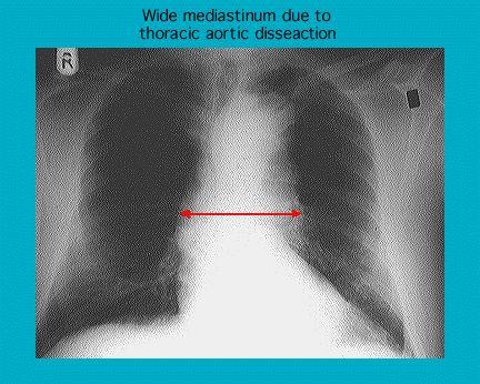 X-ray showing a wide mediastinum in a human chest due to thoracic aortic dissection with a red line indicating the area of enlargement