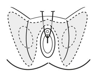 Retropubic mid-urethral mesh sling for stress urinary incontinence ...