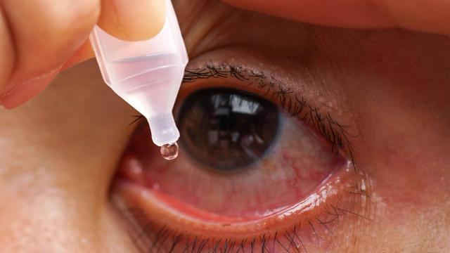 Close-up of eye drops being administered to a red, irritated eye.