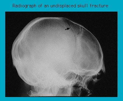 X-ray image showing a lateral view of a human skull with a subtle undisplaced fracture indicated by an arrow.