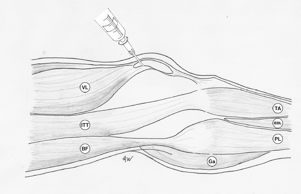 Pdf File Knee Injection Lateral approach - aspiration or injection of the knee joint – Primary ...