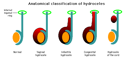 Illustration showing anatomical classification of hydroceles, including normal, vaginal hydrocele, infantile hydrocele, congenital hydrocele, and hydrocele of the cord with labeled diagrams.