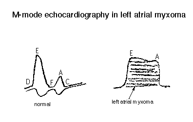 Comparison of M-mode echocardiography graphs showing normal heart function and alterations in left atrial myxoma