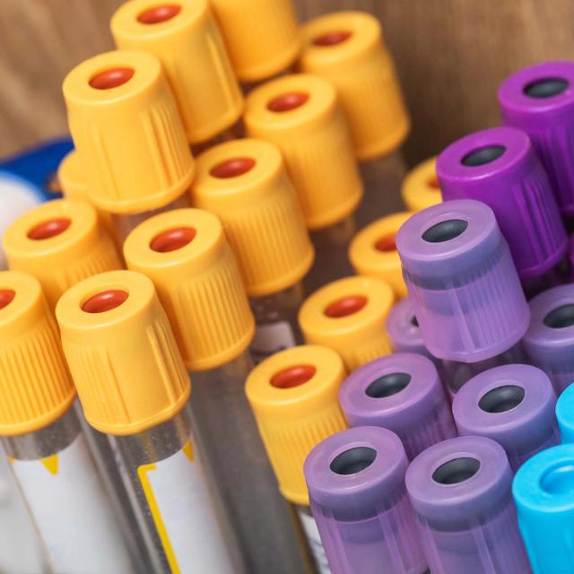 Close-up of medical blood sample tubes with yellow, purple, and blue caps.