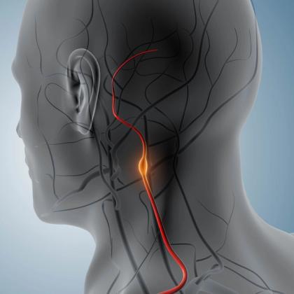 Medical illustration of a translucent human head and neck showing a red nerve with an orange swollen area.