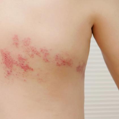 A person's torso with a red, blistering rash on the side, characteristic of shingles.