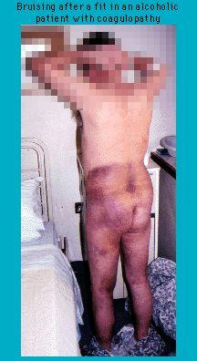 Back view of a patient with extensive bruising on legs and lower back, illustrating medical condition related to coagulopathy in an alcoholic patient.