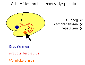 Diagram showing the site of lesion in sensory dysphasia with marked areas for Broca's area, Wernicke's area, and arcuate fasciculus, indicating impacts on fluency, comprehension, and repetition.
