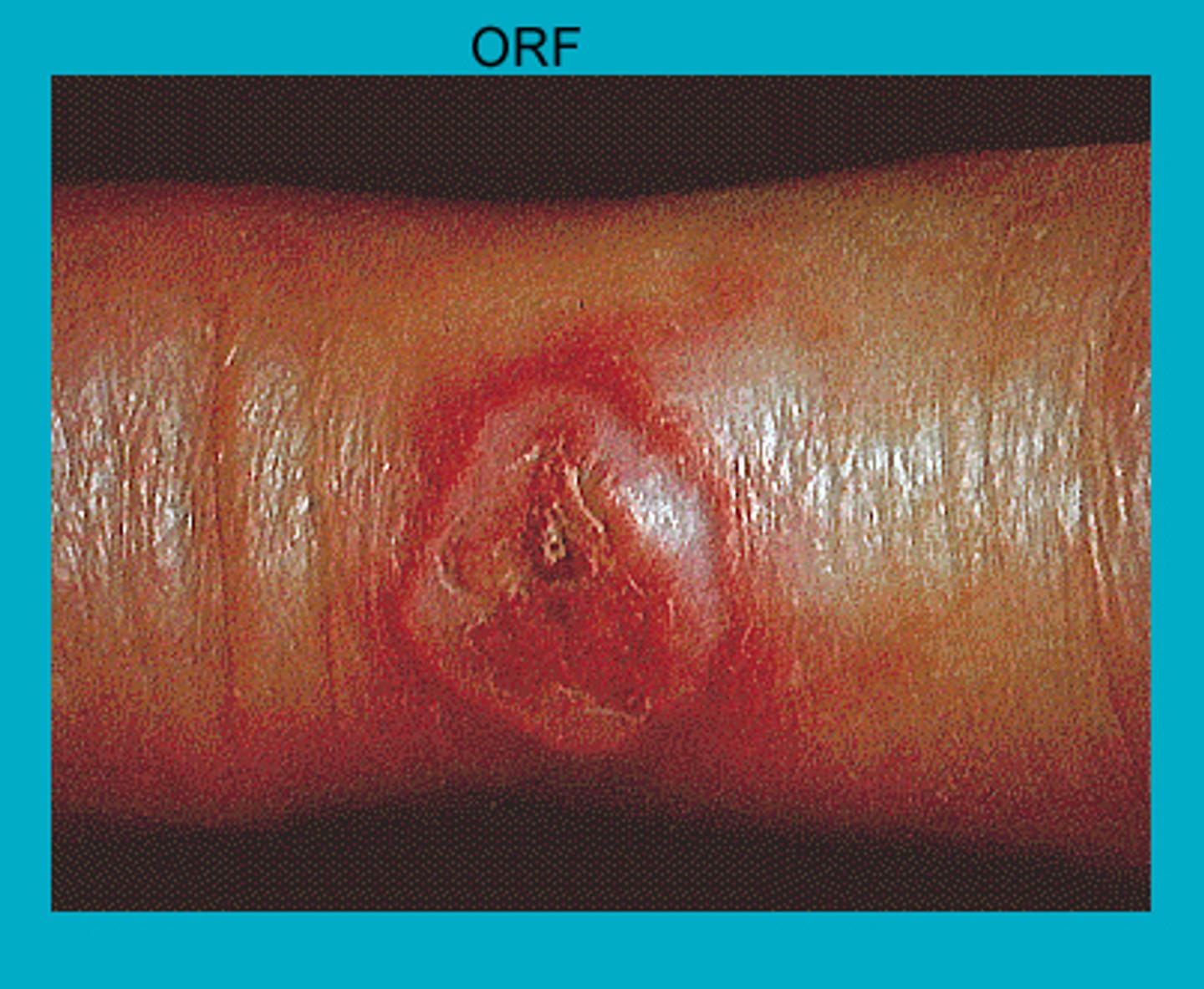 Orf – GPnotebook - GPNotebook