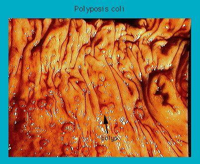 Close-up endoscopic image of a colon afflicted with polyposis coli, showing multiple polyps and inflamed mucosa.