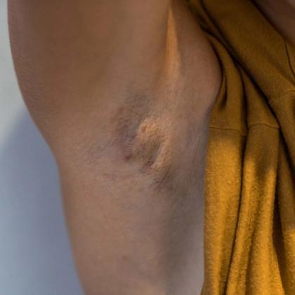 Close-up of a human knee with a visible bruise on pale skin, person wearing a yellow shirt