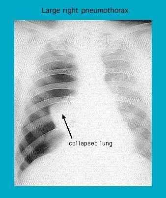 X-ray image showing a large right pneumothorax with a collapsed lung indicated by an arrow.
