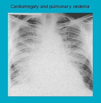 X-ray image showing cardiomagaly and signs of pulmonary edema in chest
