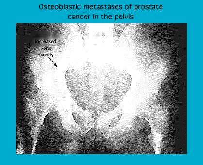 X-ray image showing osteoblastic metastases of prostate cancer in the pelvis with marked areas indicating increased bone density.