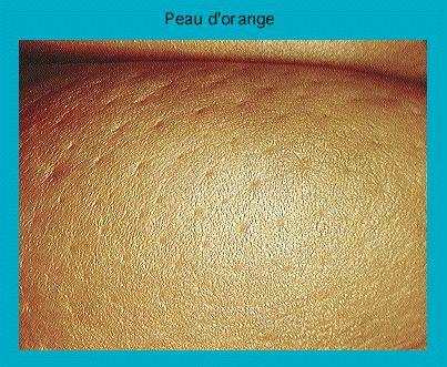 Close-up of skin showing peau d'orange texture, indicative of edema or medical conditions like cellulitis or inflammatory breast cancer.