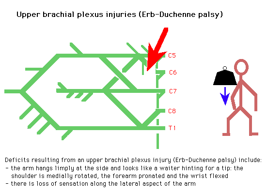 Diagram explaining upper brachial plexus injuries (Erb-Duchenne palsy) with annotations on nerve roots from C5 to T1 and an illustration of a human figure showing typical arm posture associated with the condition.