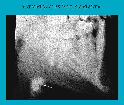 X-ray image showing a submandibular salivary gland stone in the jaw area, marked with an arrow