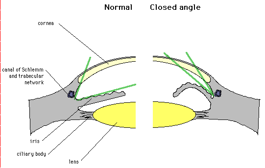Diagram comparing normal eye anatomy with closed angle glaucoma, highlighting structures like the cornea, iris, and lens.