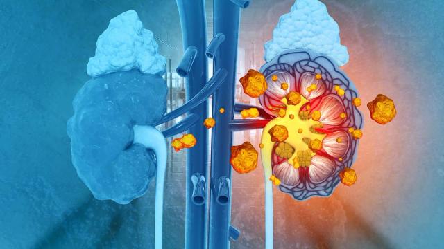 Medical illustration comparing a healthy blue kidney with a diseased kidney full of kidney stones, with a play button overlay.
