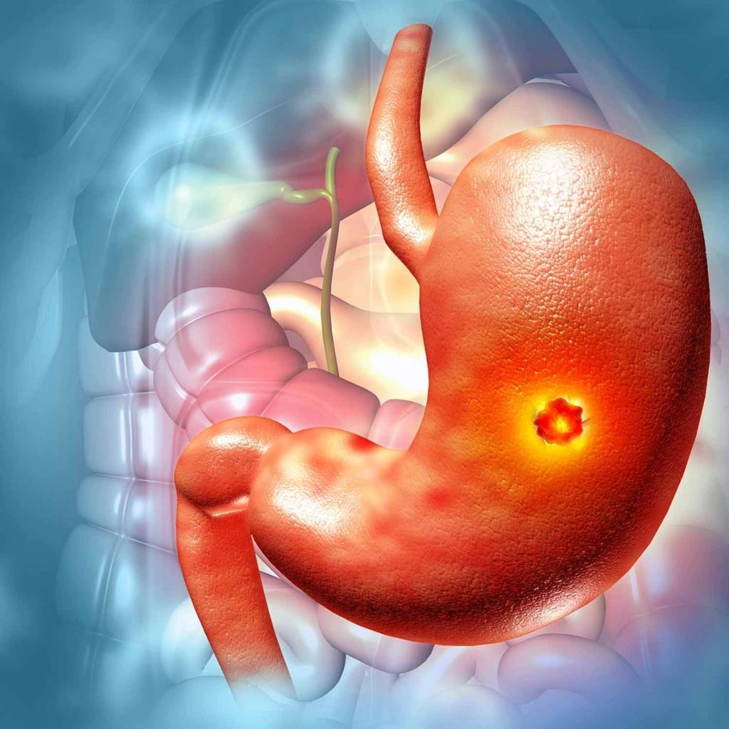 Medical illustration showing a stomach with a glowing ulcer.