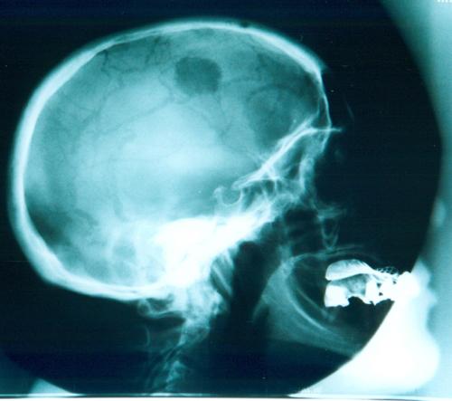 X-ray image showing a lateral view of a human skull with visible cranial, nasal, and jaw structures