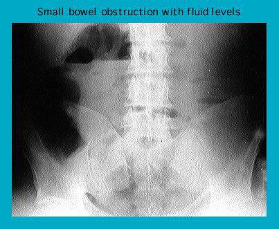 X-ray image showing small bowel obstruction with visible fluid levels in the abdomen