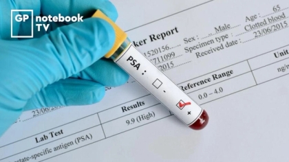 Prostate-specific antigen (PSA) test (Part 1): diagnosing and screening ...