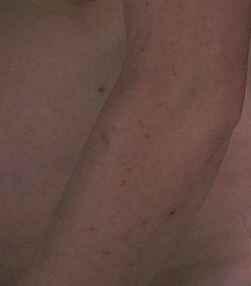 Close-up of a human arm with visible small red spots or rash on the skin.