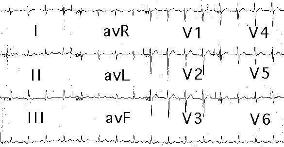 Electrocardiogram (ECG) tracing showing 12 different leads labeled as I, II, III, aVR, aVL, aVF, V1, V2, V3, V4, V5, and V6.