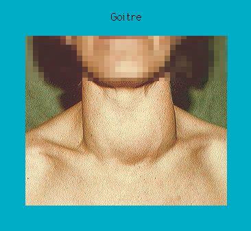 Close-up of a person's neck showing a visible goitre