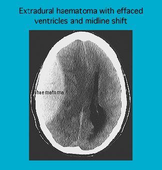 CT scan showing an extradural hematoma with midline shift and effaced ventricles