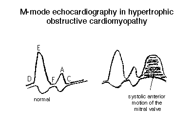 M-mode echocardiography waveform comparisons showing normal heart function and systolic anterior motion of the mitral valve in hypertrophic obstructive cardiomyopathy