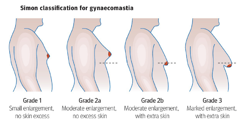 Illustration showing Simon classification for gynecomastia, depicting side views of male torsos with different grades of breast enlargement from Grade 1 to Grade 3, each labeled with descriptions of skin and enlargement levels.