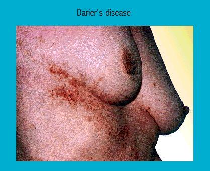 Close-up of skin showing symptoms of Darier's disease with visible red-brown crusty patches on the neck and cheek.