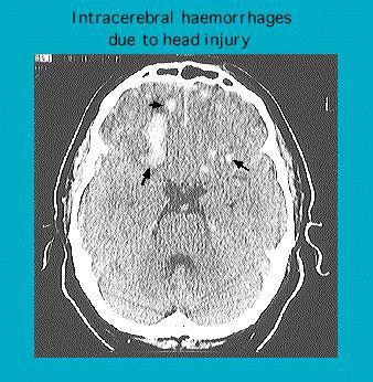 CT scan image showing intracerebral hemorrhages marked by arrows, indicating brain damage due to head injury