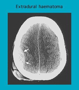 CT scan of a brain showing an extradural haematoma with highlighted affected areas