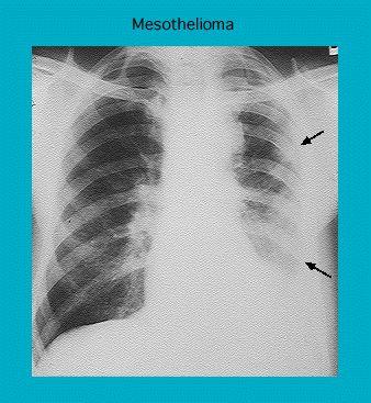 X-ray image showing lungs with markings indicating Mesothelioma, highlighted by arrows on abnormalities