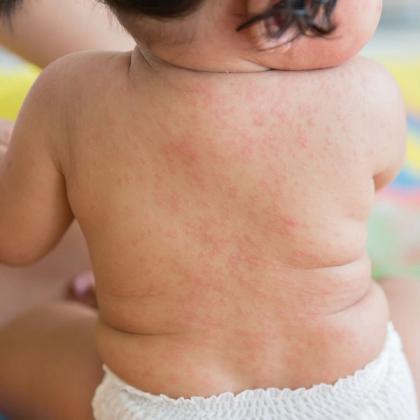 Close-up of a baby's back showing a rash for medical or health-related awareness.