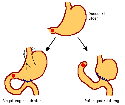Diagram showing treatments for duodenal ulcer, including vagotomy and drainage, and Polya gastrectomy procedures.