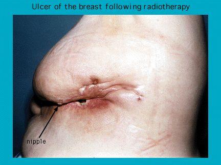 Close-up photo of an ulcer on a breast following radiotherapy, showing skin texture and surgical markings.