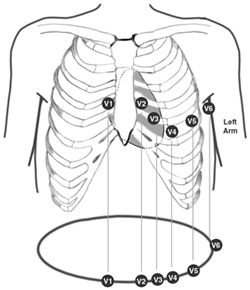 Diagram showing the placement of ECG leads V1 through V6 on the rib cage with labeled positions related to the left arm