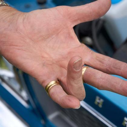 Close-up of a person's dirty hand showing a cut on the thumb with a blurred blue background.