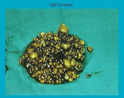 A pile of various-sized gallstones on a teal background