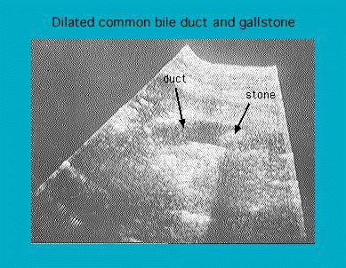 Ultrasound image showing a dilated common bile duct and gallstone with labeled annotations for duct and stone.