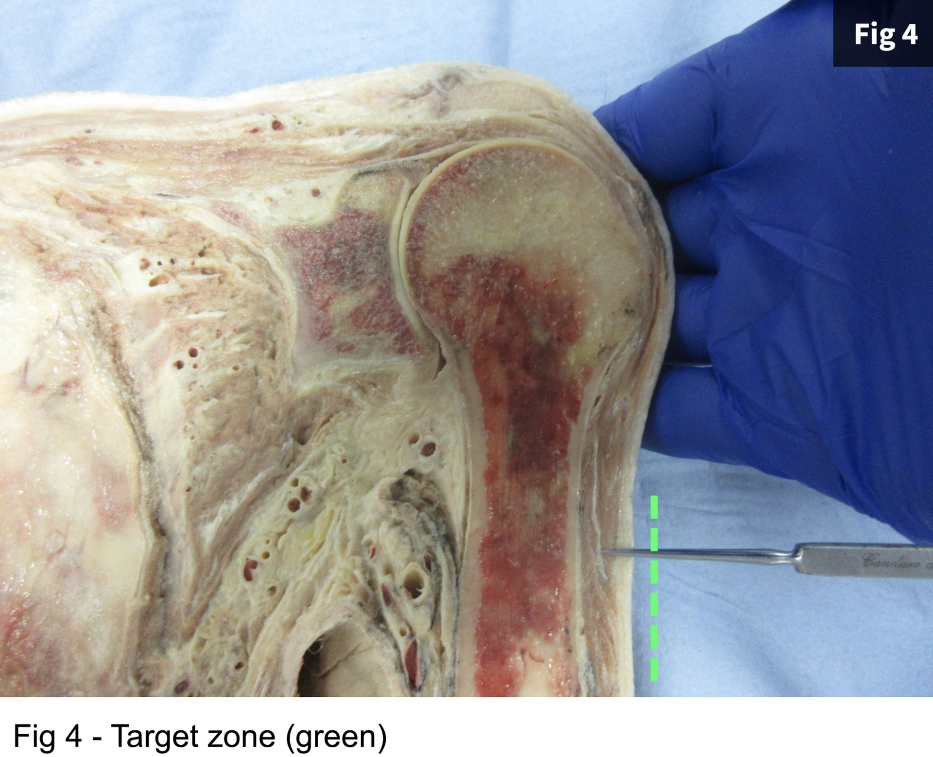 Close-up of a human cadaver knee dissection highlighting anatomical structures with a gloved hand pointing to a specific area marked by a green line.