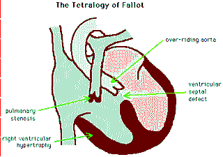 Diagram of the Tetralogy of Fallot – Primary Care Notebook - GPNotebook