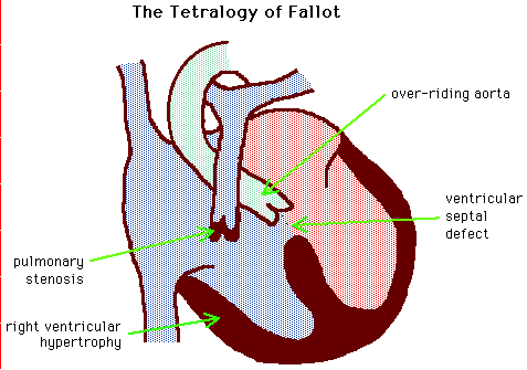 Illustration of a heart with Tetralogy of Fallot showing features like over-riding aorta, ventricular septal defect, pulmonary stenosis, and right ventricular hypertrophy.