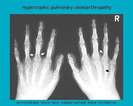 X-ray image of hands showing signs of hypertrophic pulmonary osteoarthropathy with labeled new subperiosteal bone formation.
