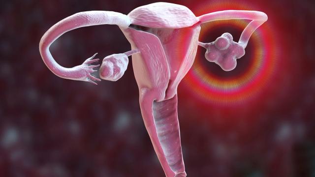 3D rendering of the female reproductive system with a polycystic ovary highlighted in red.