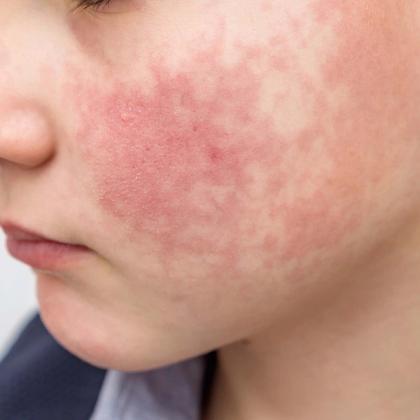 Close-up of a person's face showing a widespread red, blotchy skin rash.
